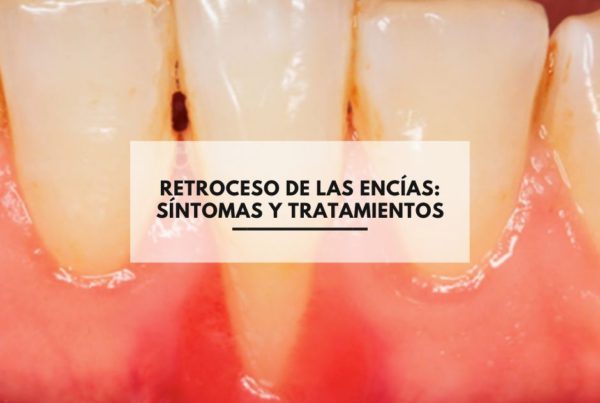 Retroceso de las encías: síntomas y tratamientos