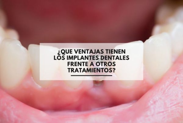 ¿Que ventajas tienen los implantes dentales frente a otros tratamientos?
