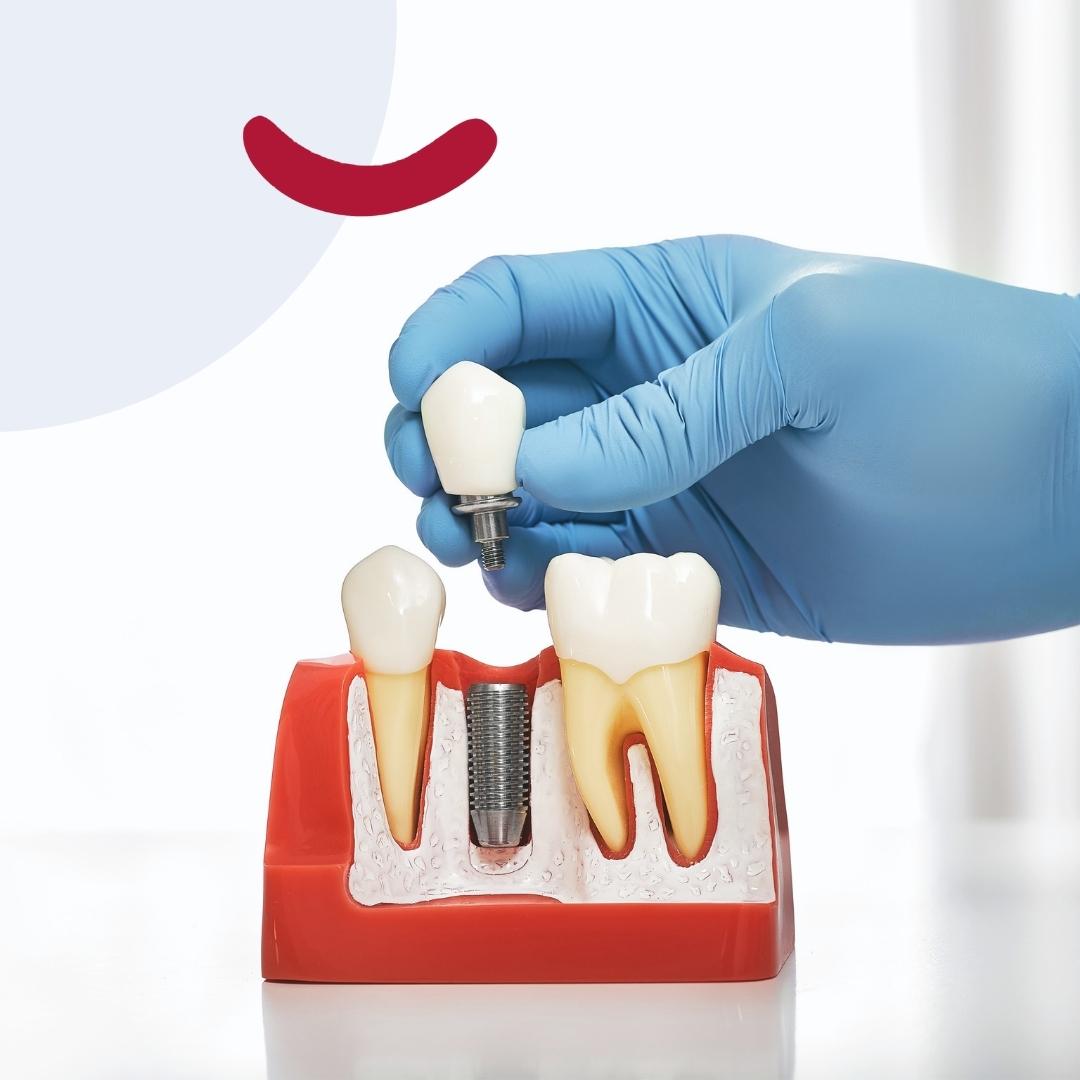 para qué sirven los implantes dentales
